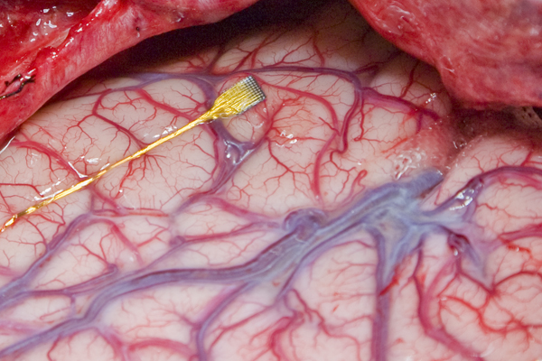 bionic implants micro cip in creierul uman
